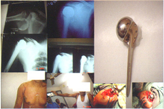 Shoulder Replacement Surgery, including metalball with stem, x-ray of broken shoulder