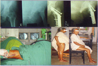 succesful knee surgery by Doctor Amitabha Narayan Mukherjee