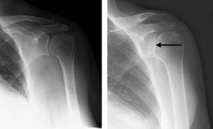 (Left) An X-ray of a healthy shoulder joint. (Right) Osteoarthritis of the shoulder. Note the decreased joint space (arrow).