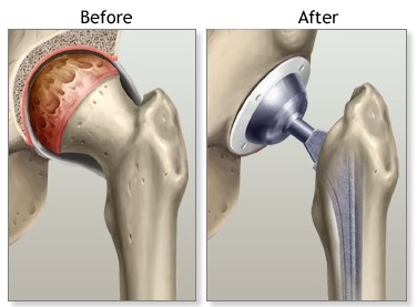 best doctor for total hip replacement in kolkata