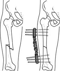 Best Bone Fracture Surgeon In Kolkata