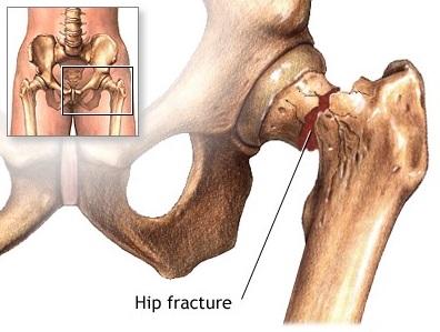 5 Tips for a Successful Total Hip Replacement Recovery - CMRI Kolkata