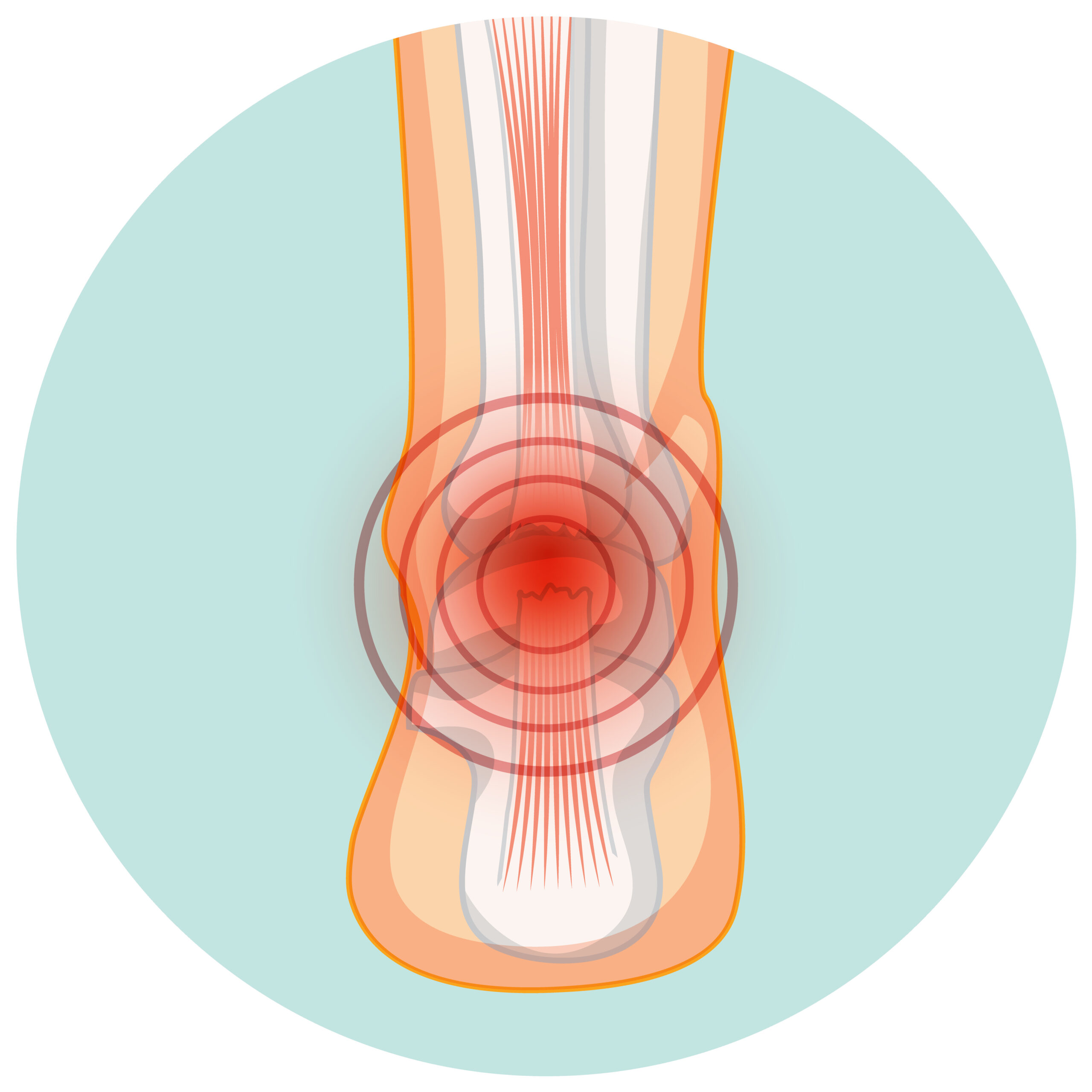 achilles tendonitis | achilles heel | achilles injury | worldclass achilles tendonitis treatment in India