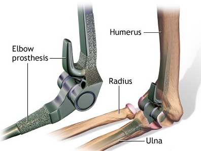 graphical image, after elbow replacement surgery, including prosthesis